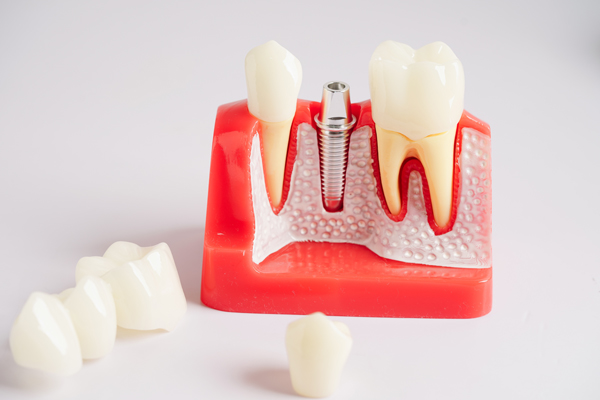Oral Surgery: Who Is A Candidate For Dental Implants?